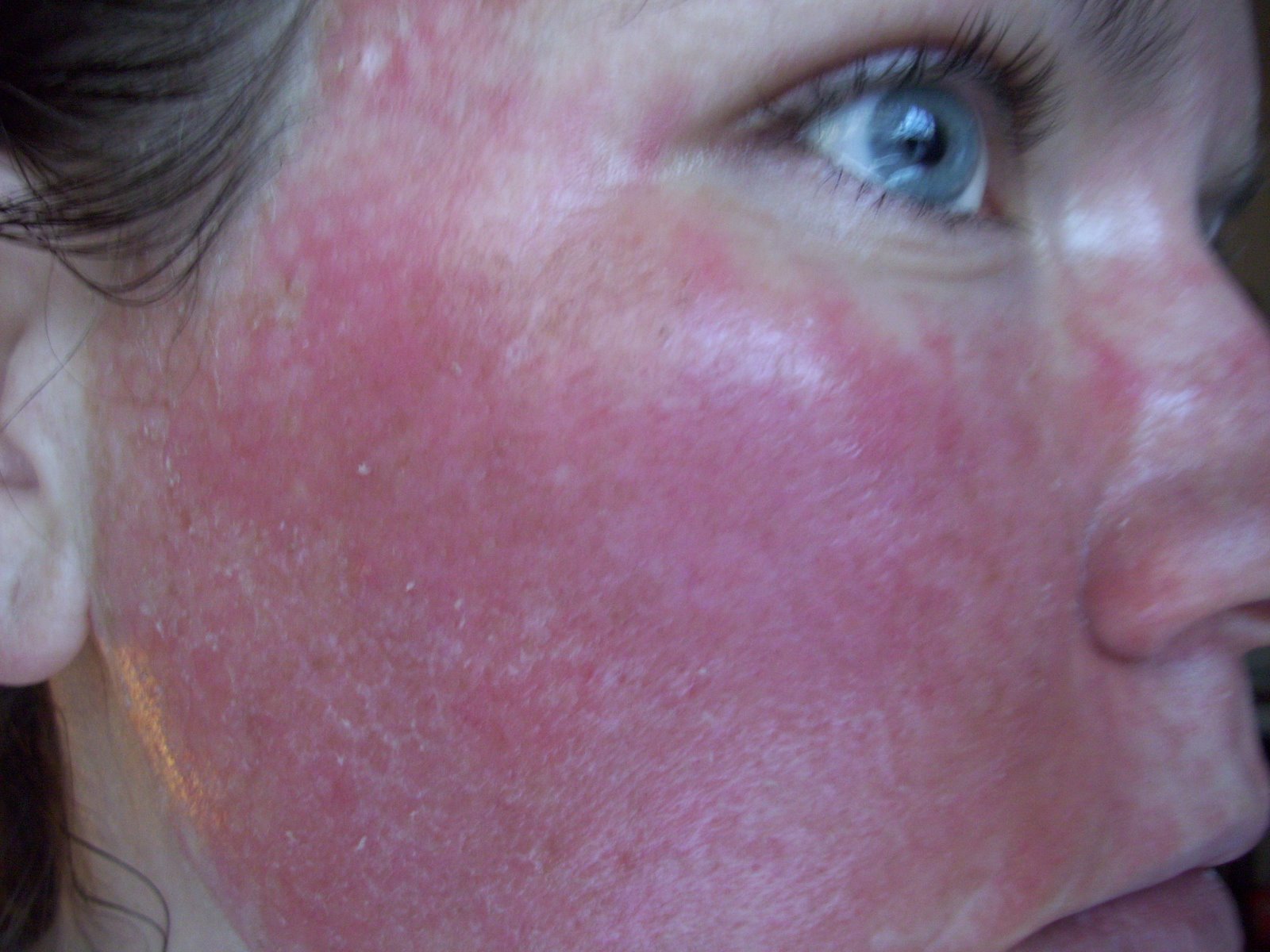 [Post+Pearl+Day++3+Peeling+Cheek.JPG]