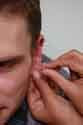 Ear Acupuncture