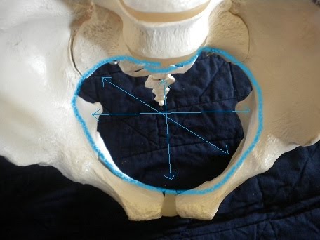 Platypelloid Pelvis Shape