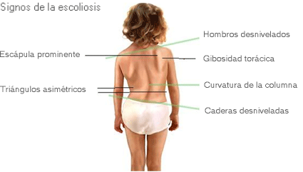 Criança Com Escoliose Durante a Fisioterapia Foto de Stock