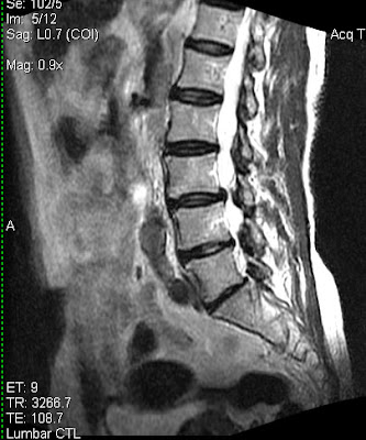 slipped disc mri