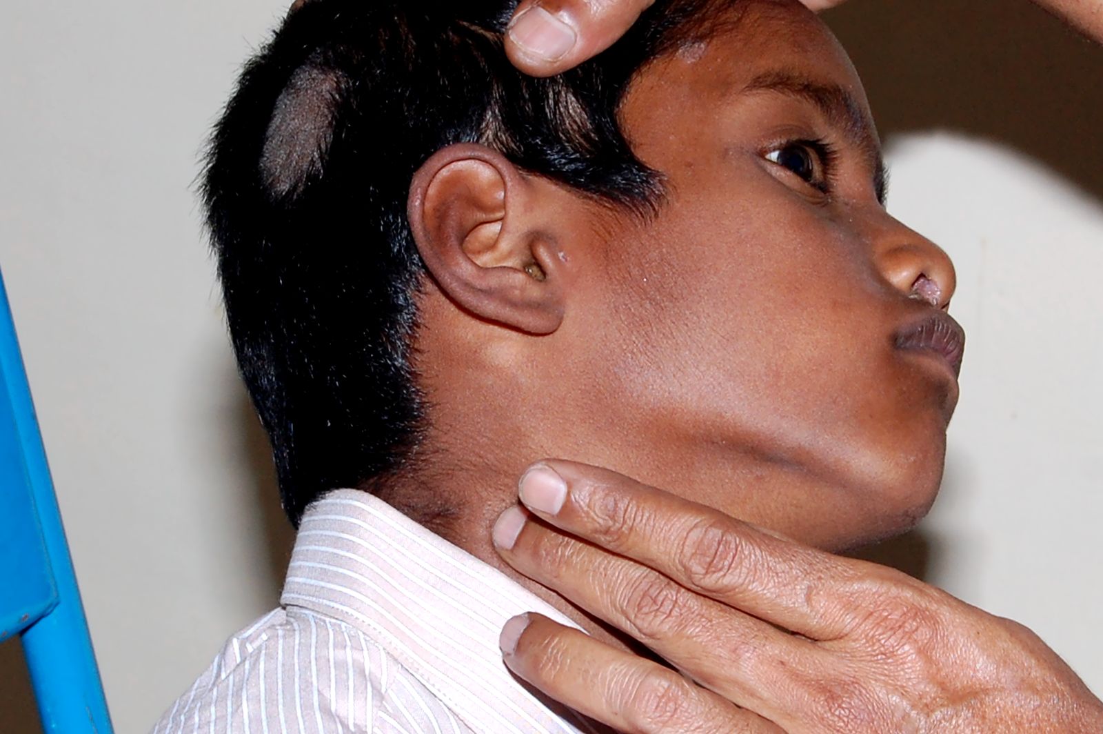 acwerkleprosyday.blogs...lymph node enlarged behind