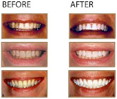 Resultados tipicos de Blanqueamientos Dentales