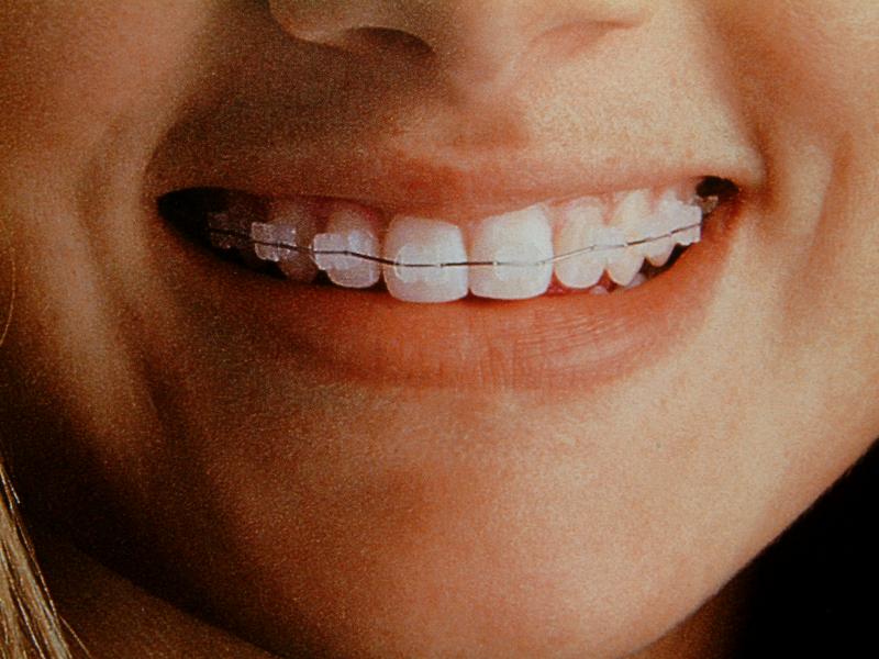 braces clear teeth dental cost damon metal put orthodontics brace vs them average ceramic american take much invisible colors std