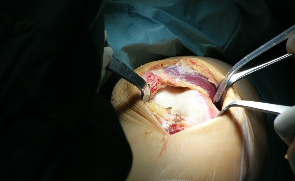 Total Knee Replacement Ligament Balancing in Total Knee