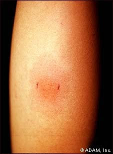 Positive or Negative TB test?