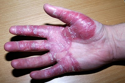 La tabla de los ungüentos de la psoriasis
