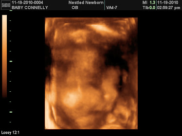 Jackson 3D ultrasound