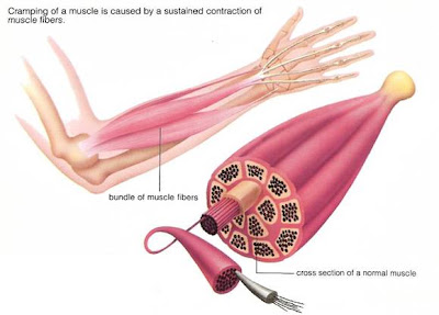 Muscle cramps?  Role of Low potassium & Magnesiums