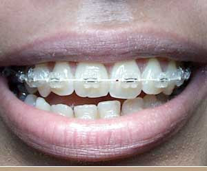 Clear Braces Cost