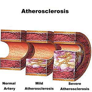 الثوم أفضل مضاد حيوي عبر التاريخ  Atherosclerosis_Definition_Treatment_Causes+_Risk_Factors_Symptoms_Prevention