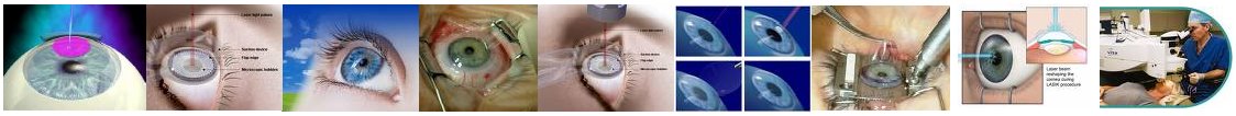 New Lasik Eye Surgery Blog - Lasik Surgery Cost Information