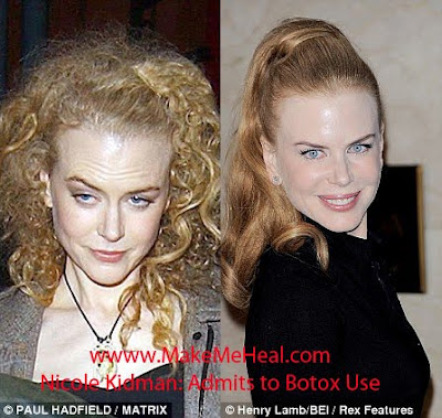 Nicole Kidman Plastic Surgery on Nicole Kidman Plastic Surgery 2 Jpg