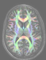 Diffusion Tensor Imaging