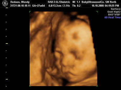 3d ultrasound pictures at 20 3d ultrasound pictures. 3d ultrasound pictures at 20