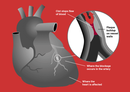 heart attack diagram