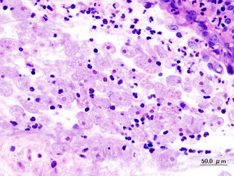 Amoebic dysentery in colon biopsy