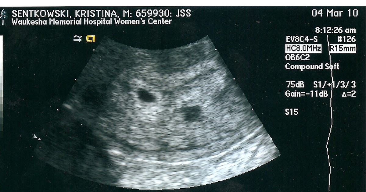 Our Journey to Parenthood: 3/4/10 ultrasound pic.....5 ...