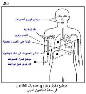 رسم توضيحي حول مرض الطاعون