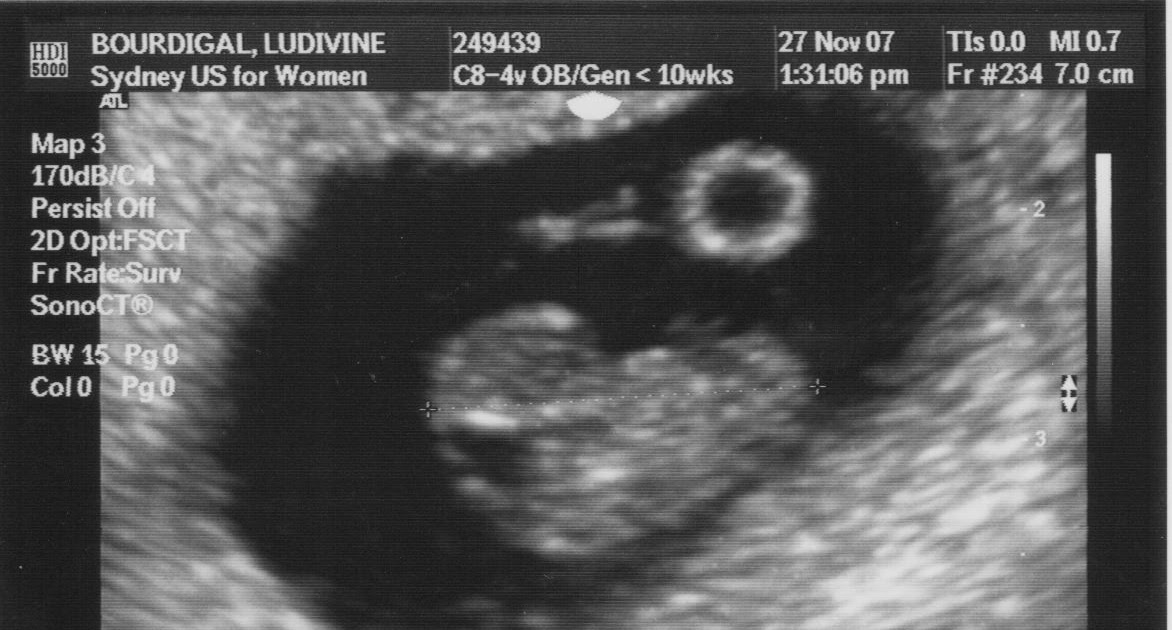 Le Blog de Bebe Echographie 6 semaines / 6week ultrasound
