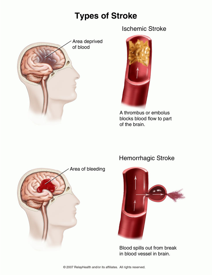 Clogged Blood Vessels