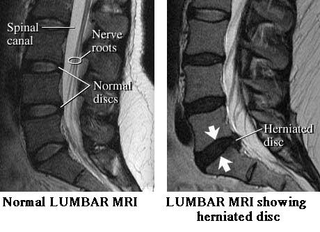 mri lumbar disc spine herniated scan normal bulging pain lower discs pathology health imaging lumber nerves medical spinal herniation side