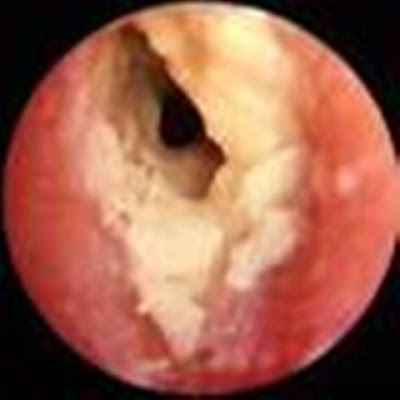 Ciprodex Otic