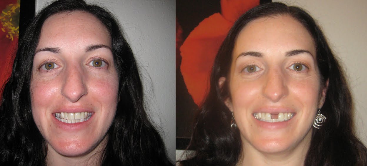 Before And After Braces Gaps. 2 1/2 weeks until races!
