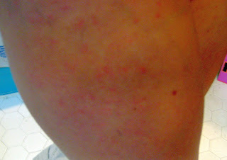 I have Fifth Disease. One of the kids in the neighborhood had it a few weeks ... I have Fifth Disease. One of the kids in the neighborhood had it a few weeks ...