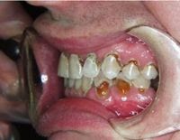 Mountain dew mouth kids - corpslopers