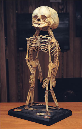 Mutter Museum, el museo del terror Better+twin+skeleton