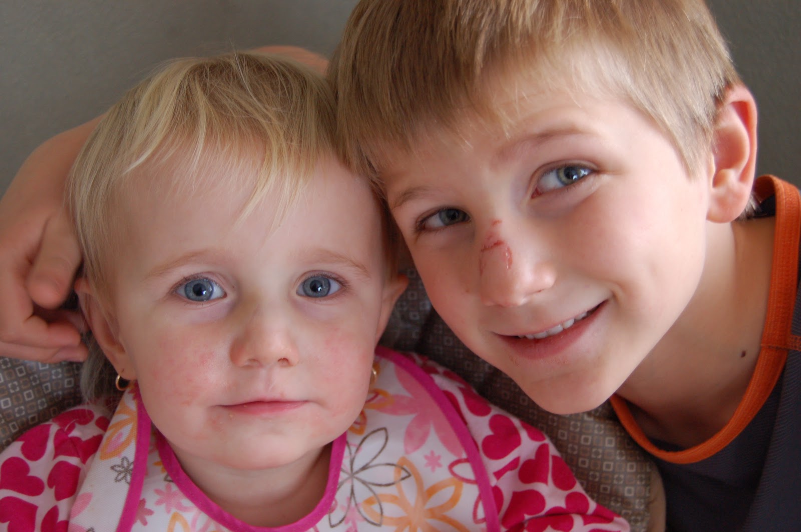 Small Wonders Two Broken Noses