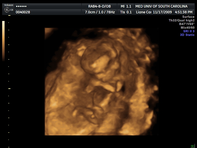 fetus at 12 weeks. fetus at 12 weeks.
