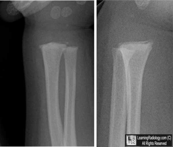 Incomplete Fracture Kandace's Anatomy Blog-2.bp.blogspot.com