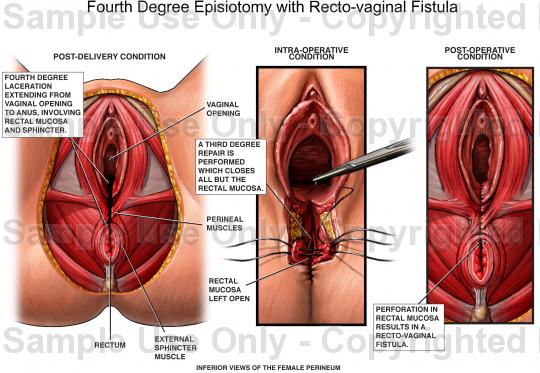 LESIONES PERINEALES