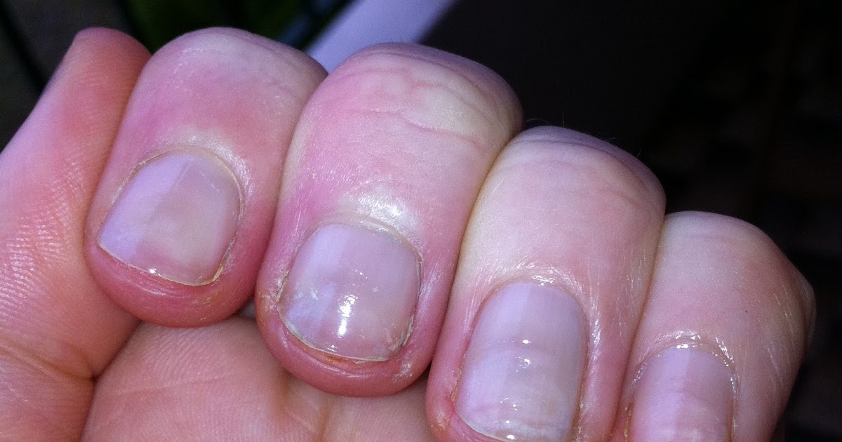 miss chew The truth about healing your nails after having acrylics...