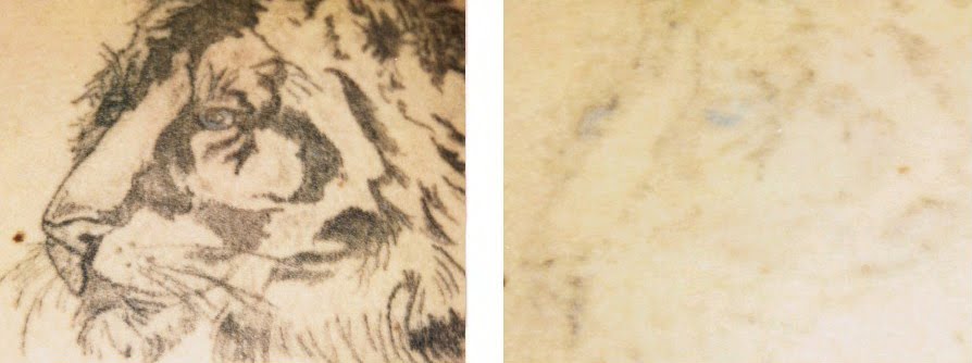 Tattoo Laser Removal Cost Tattoo Laser Removal Cost