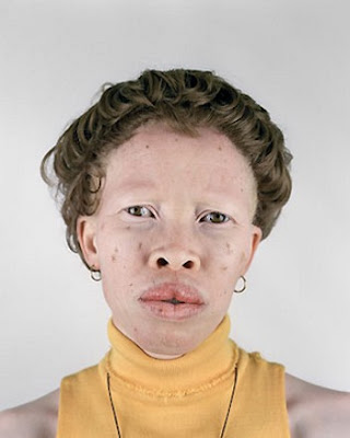 Ugly Albino Women 4