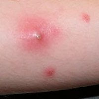 Leg Staph Infection