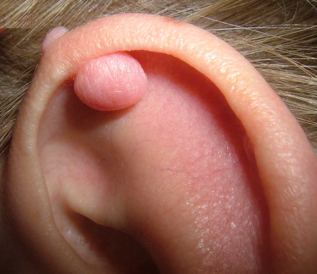[Ear+Plug+Keloid.jpg]