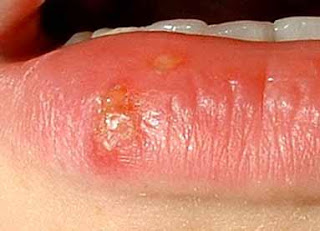 calentura labial herpes