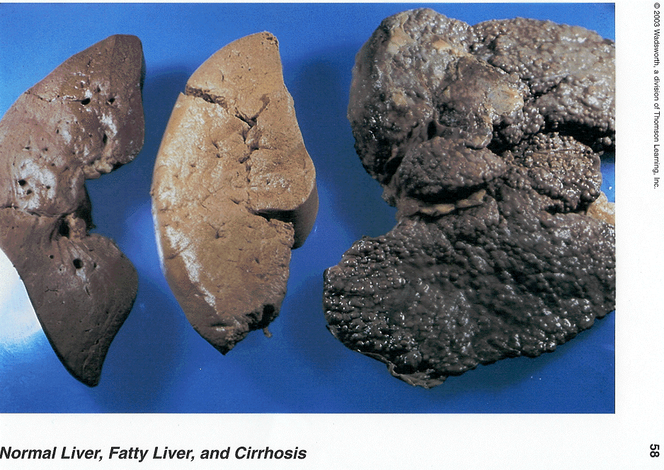 Fat On Liver