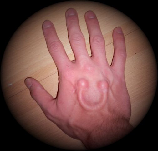 Hand Implants
