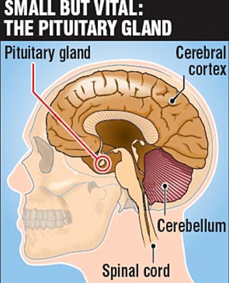 pituitary gland disorders