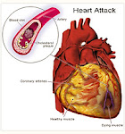 Cardiovascular Disease