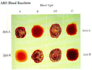 Golongan darah o tidak dapat ditransfusi oleh golongan darah b karena akan terjadi reaksi antara