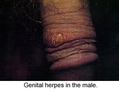 Herpes Outbreak Symptoms