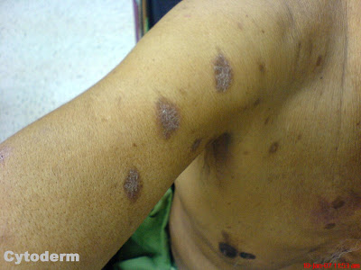 Deep Fungal Infections