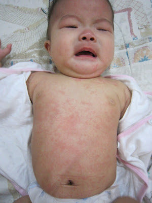 Baby Roseola