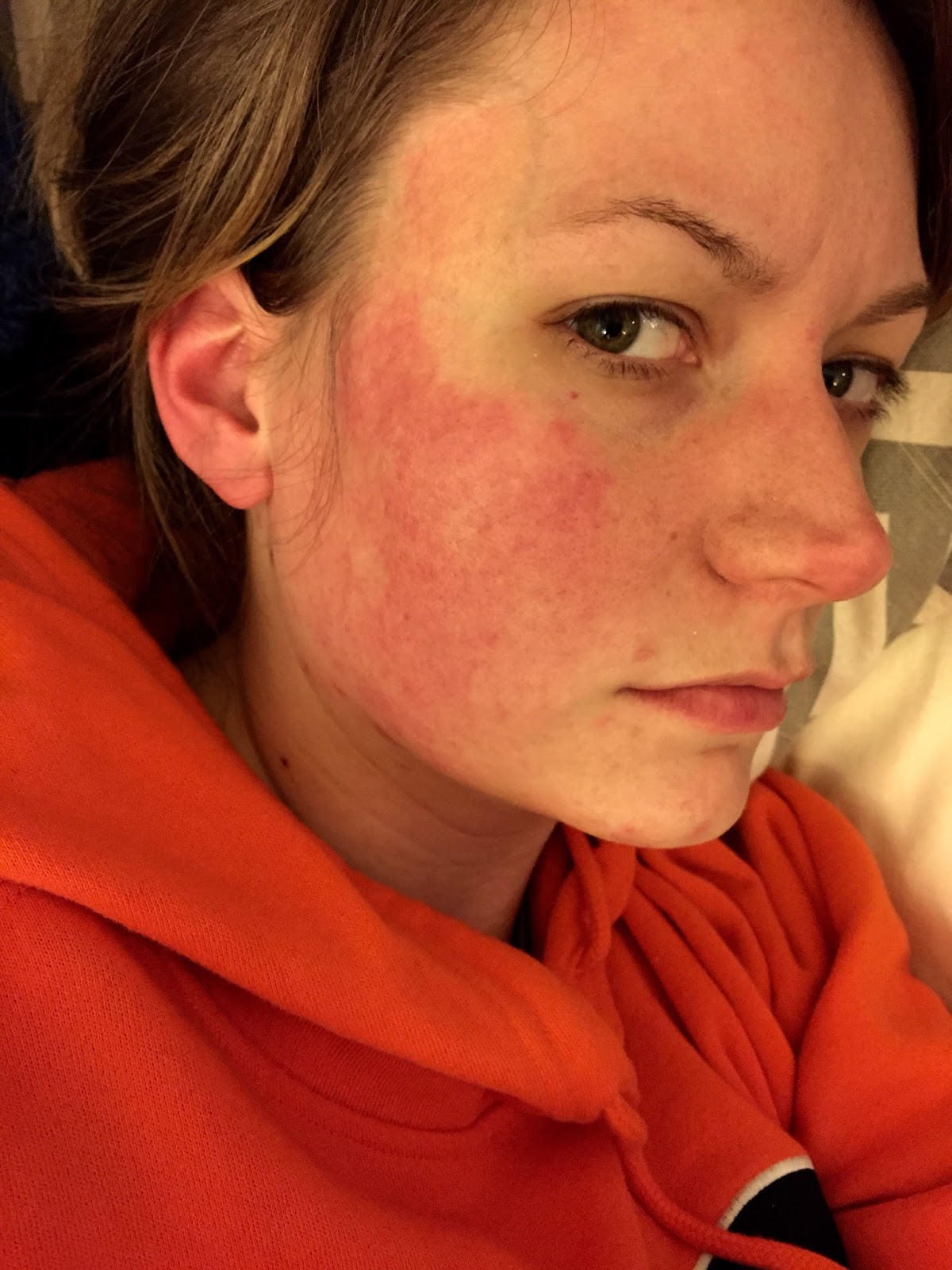 Scarlet Letters, dealing with vascular rosacea, face flushing, burning